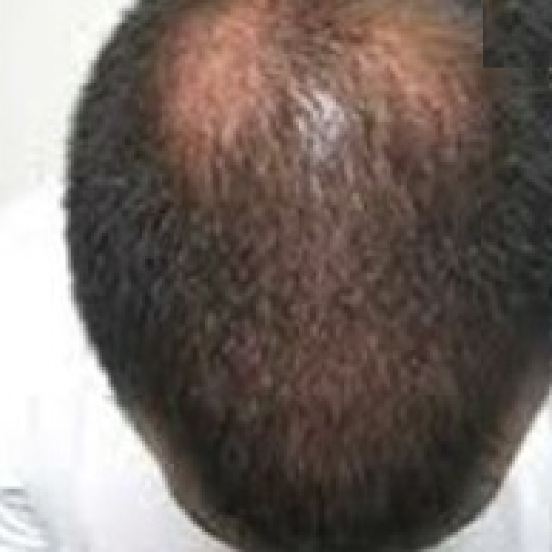 Top view of a men's head with visible baldness before hair transplant surgery.