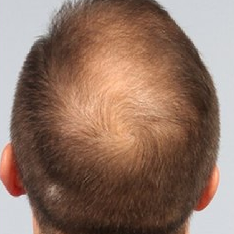 Top view of a men's head with visible scalp and baldness before hair transplant surgery.