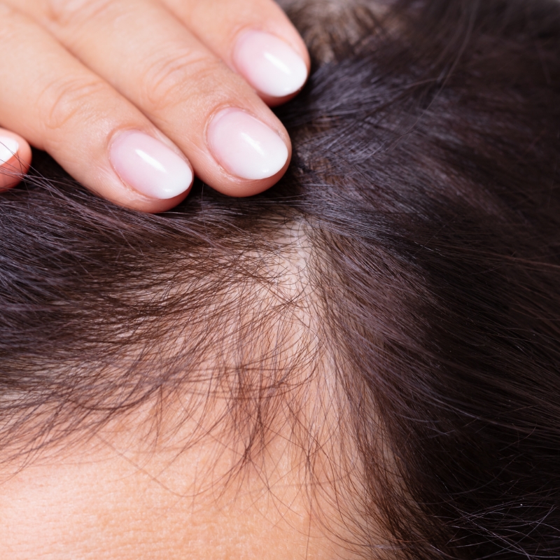 A visible scalp of a patient as a result of hair loss before a PRP treatment.