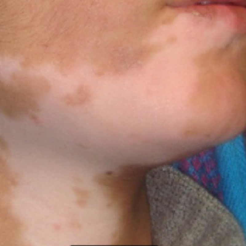 A patient with white patches of Vitiligo on the jaw area before treatment at AKJ Skin & Laser Centre, Chennai.