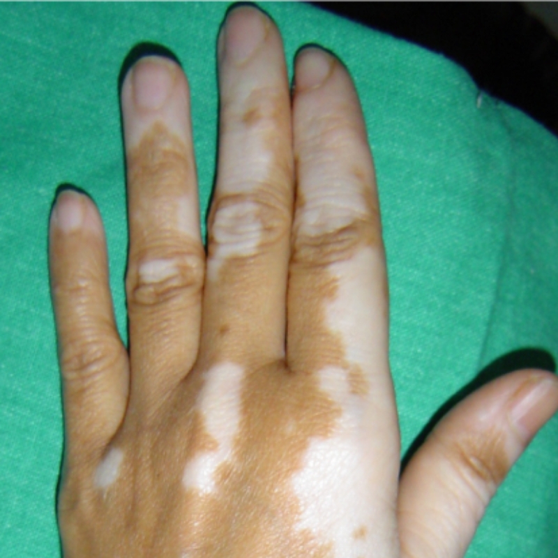 A patient with white patches of Vitiligo on the hands before treatment at AKJ Skin & Laser Centre, Chennai.