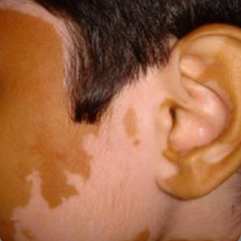 A patient suffering from white patches of Vitiligo around the ear area before treatment at AKJ Skin & Laser Centre, Chennai.