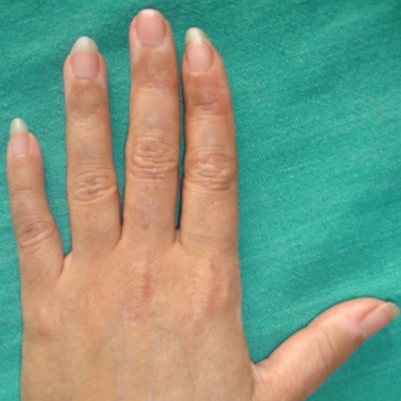 A patient with diminished white patches of Vitiligo on the hands after treatment at AKJ Skin & Laser Centre, Chennai.