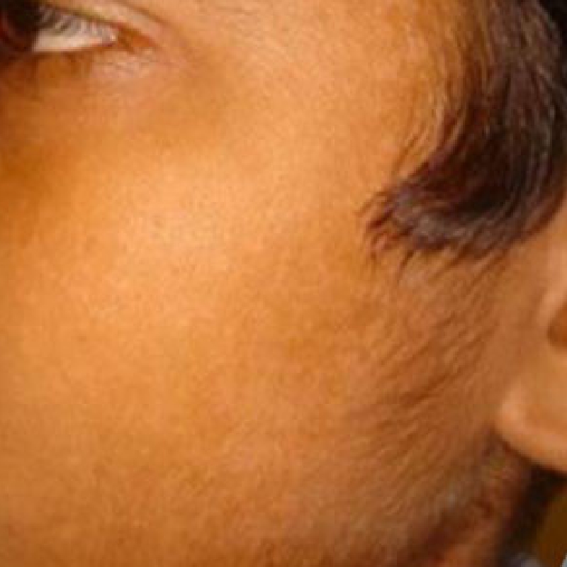 A patient with clear skin and the white patches of Vitiligo removed after the treatment at AKJ Skin & Laser Centre, Chennai.