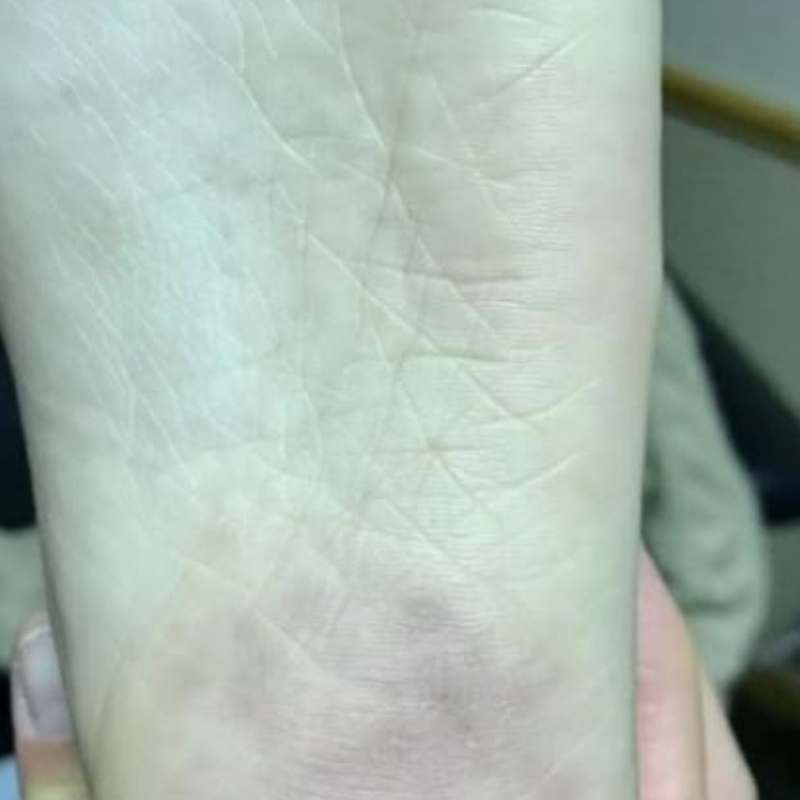 A patient showing foot with diminished warts after the wart removal treatment at AKJ Skin & Laser Centre, Chennai.