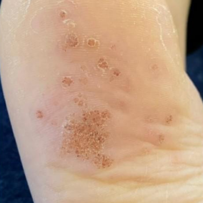A patient showing warts formed on the foot before the radiosurgery for wart removal at AKJ Skin & Laser Centre, Chennai.