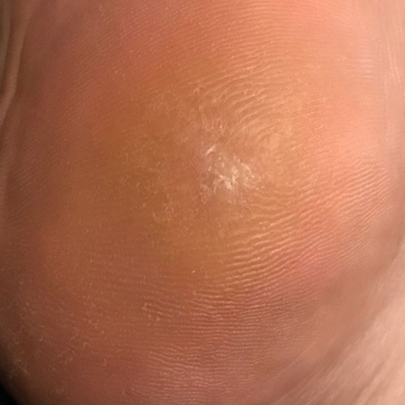 Wart free foot of a patient after the wart removal treatment at AKJ Skin & Laser Centre, Chennai.