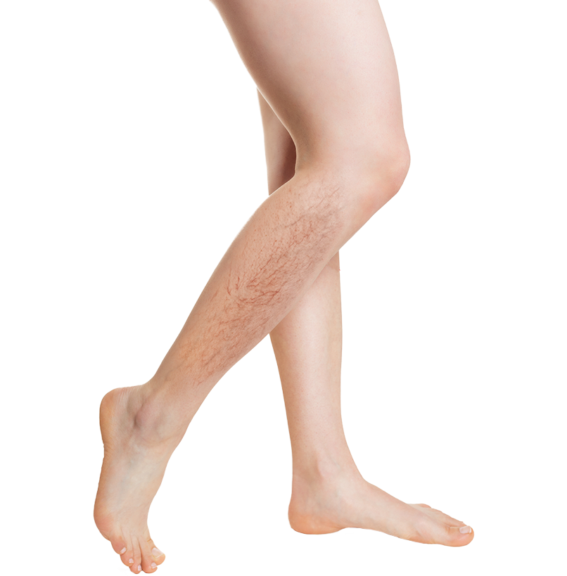 Hairy and varicose veins affected legs before treatment at AKJ.