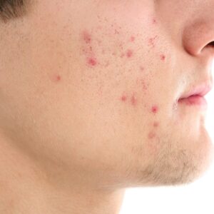 A close-up shot of a man with acne all over his face waiting for a laser acne treatment.