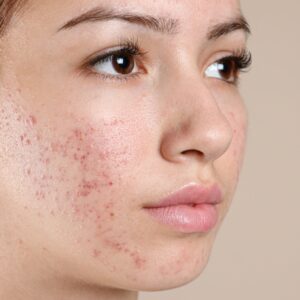 A close-up shot of a woman's face showing acne & acne marks.