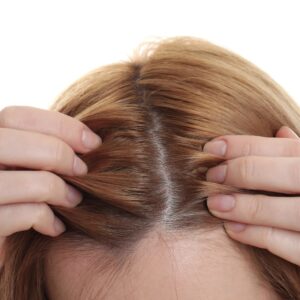 A female patient shows her visible scalp due to hair loss before hair transplantation.