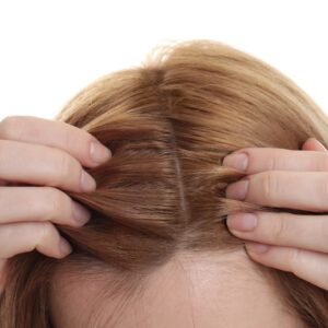 A female patient shows her visible scalp due to hair loss before hair transplantation.