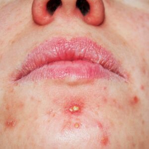 A female patient with acne all over her face before starting her laser acne treatment at AKJ Skin and Laser Clinic in Tirunelveli.