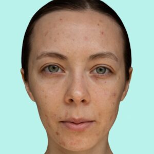 A close-up image of a female patient before a chemical peel treatment for acne problems at AKJ Skin & Laser Clinic, Tirunelveli.