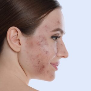 A female patient with acne scar marks and a dull face before a chemical peeling.