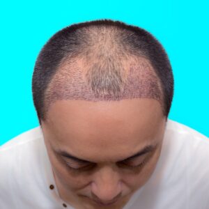 A male patient reveals his scalp with new hair after a hair transplant treatment at AKJ Skin & Laser Clinic, Tirunelveli.