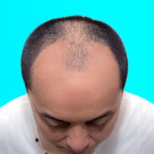 A male patient reveals his bald scalp prior to his hair transplant treatment at AKJ Skin & Laser Clinic, Tirunelveli.