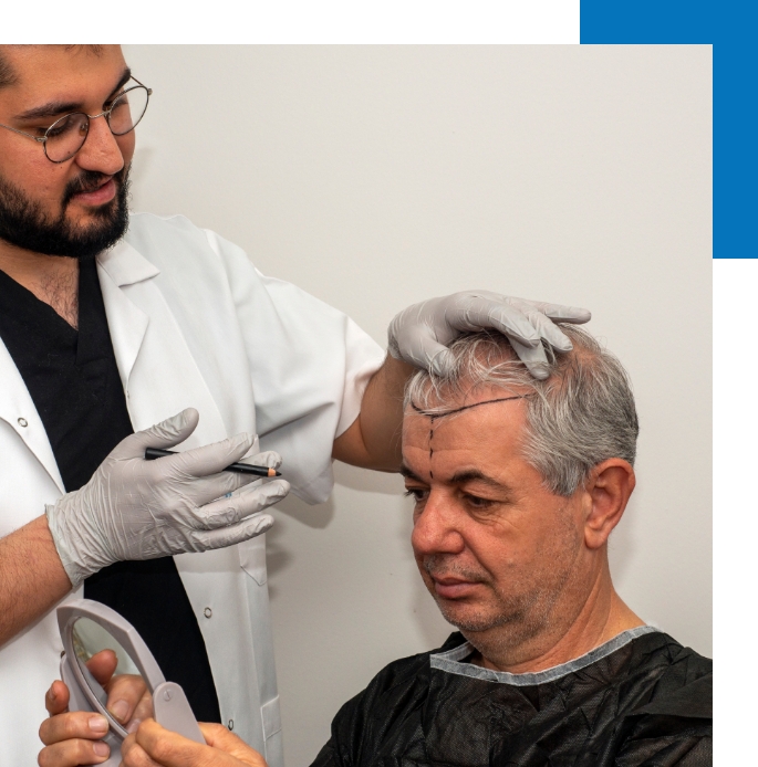 Marking hair line point of receding hair line for hair transplant surgery.