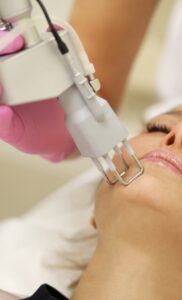 A female patient undergoing a laser acne treatment procedure on her face.