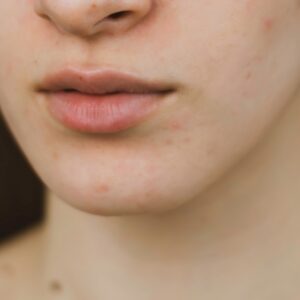 A female patient with acne scars all over her face before her laser acne skin treatment at AKJ Skin and Laser Clinic in Tirunelveli.