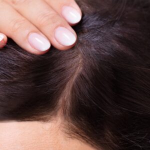 A patient showing a scalp covered with dense hair after PRP treatment.