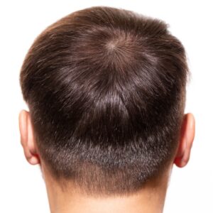 A male patient showing a scalp densely covered with hair after PRP treatment.