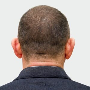 A male patient with a scalp covered with dense hair after PRP treatment.