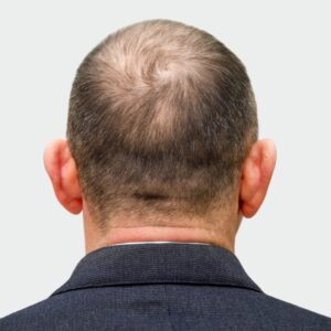 A male patient with a visible scalp because of hair loss before PRP treatment.