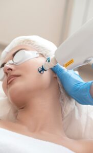 A close-up shot of a woman undergoing a laser acne treatment in a laser skin care center.