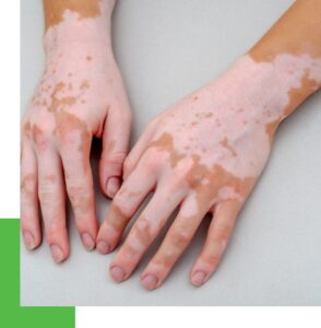 A patient is showing white patches of Vitiligo on the hands.
