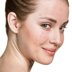 A happy woman with acne and acne marks on her face before the acne treatment.