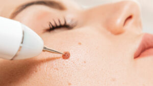 A close-up shot of the removal of a birthmark from a client's cheek with a laser device.