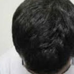 A male patient showing a scalp densely covered with hair after PRP treatment.