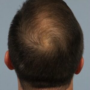 A male patient showing a hair-covered scalp after PRP treatment at AKJ Skin & Laser Clinic, Tirunelveli.