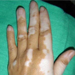 A resized image of a patient with white patches of Vitiligo on the hands before treatment at AKJ Skin and Laser Clinic in Tirunelveli.