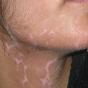 A resized image of a patient with reduced white patches of Vitiligo on the jaw area after treatment at AKJ Skin and Laser Clinic in Tirunelveli.