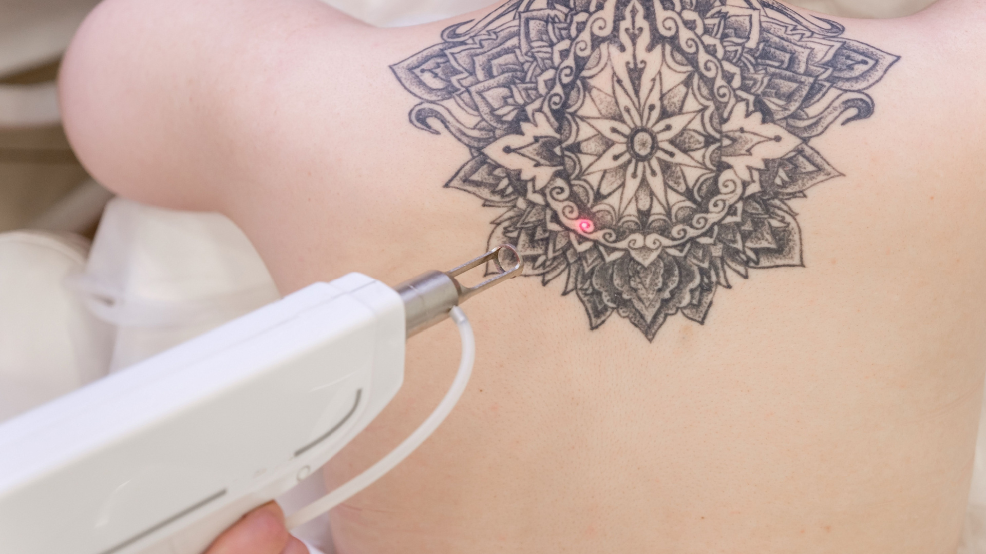 A beautician holds a laser device over the tattooed back of a girl to remove an unwanted tattoo.